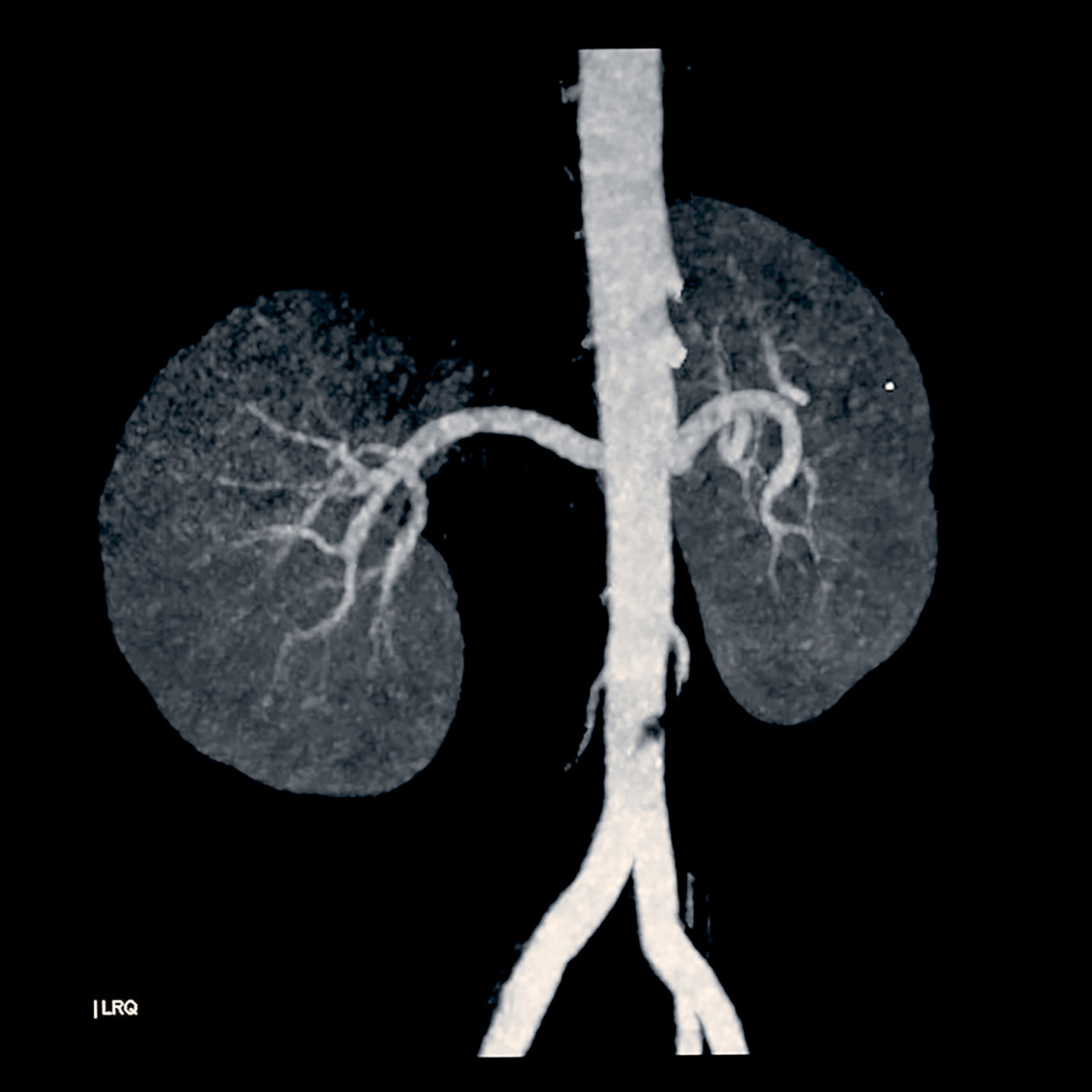 Ultrasound image of kidneys