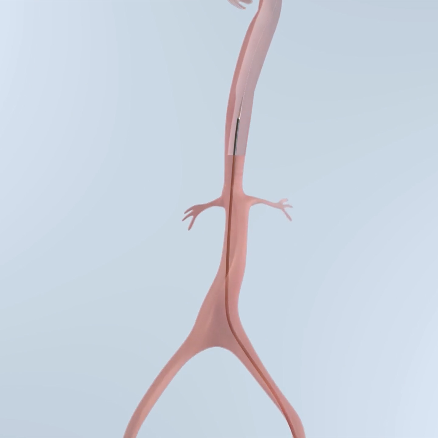 Emboliner efficient deployment